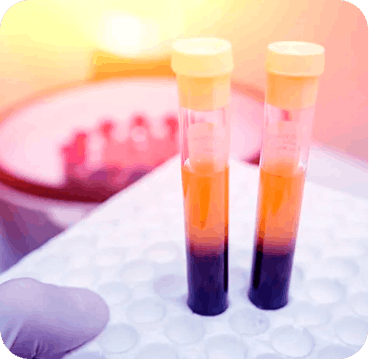 PRP (Plasma Rico em Plaquetas)